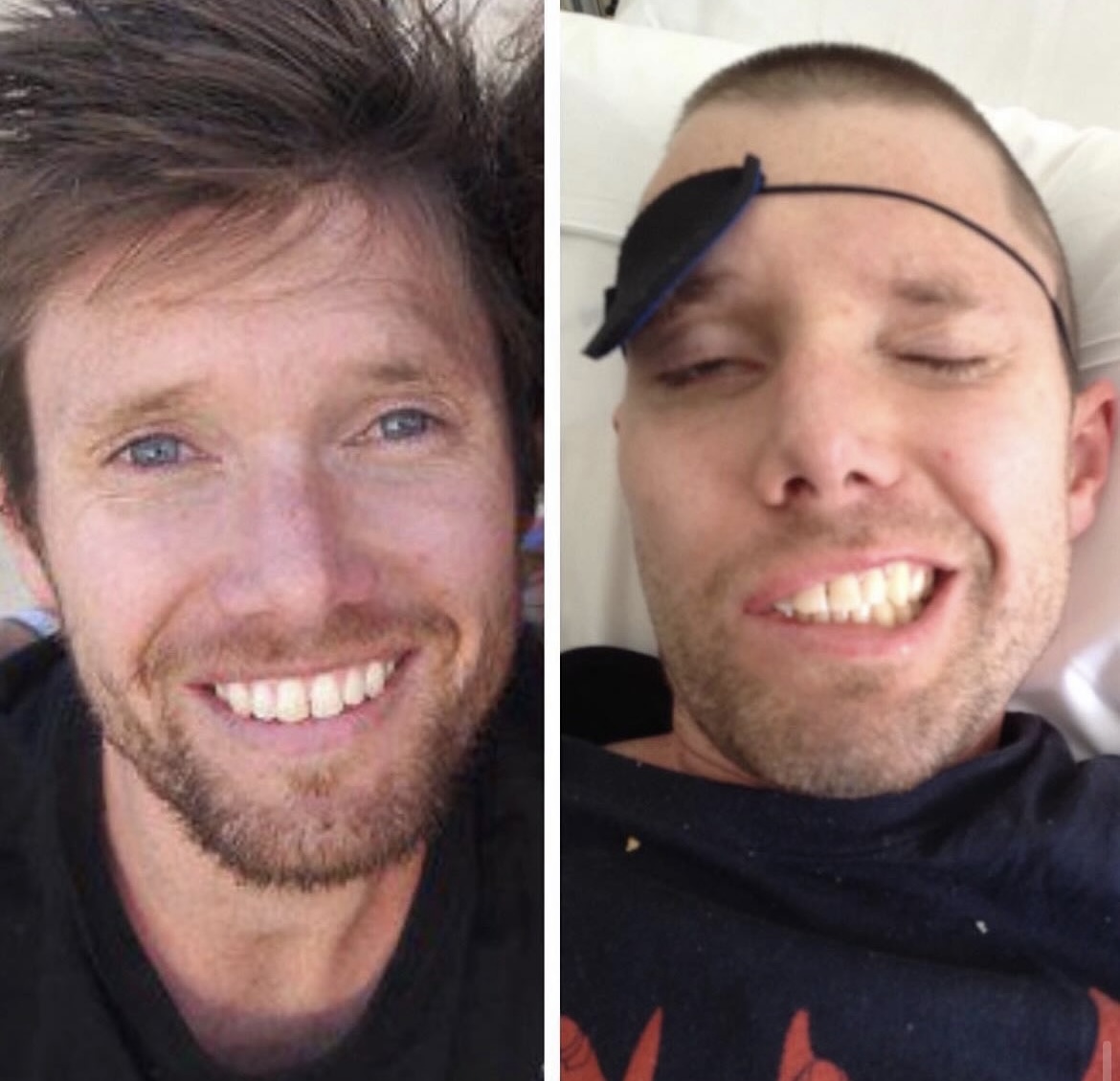 12. Facial paralysis – Bells Palsy